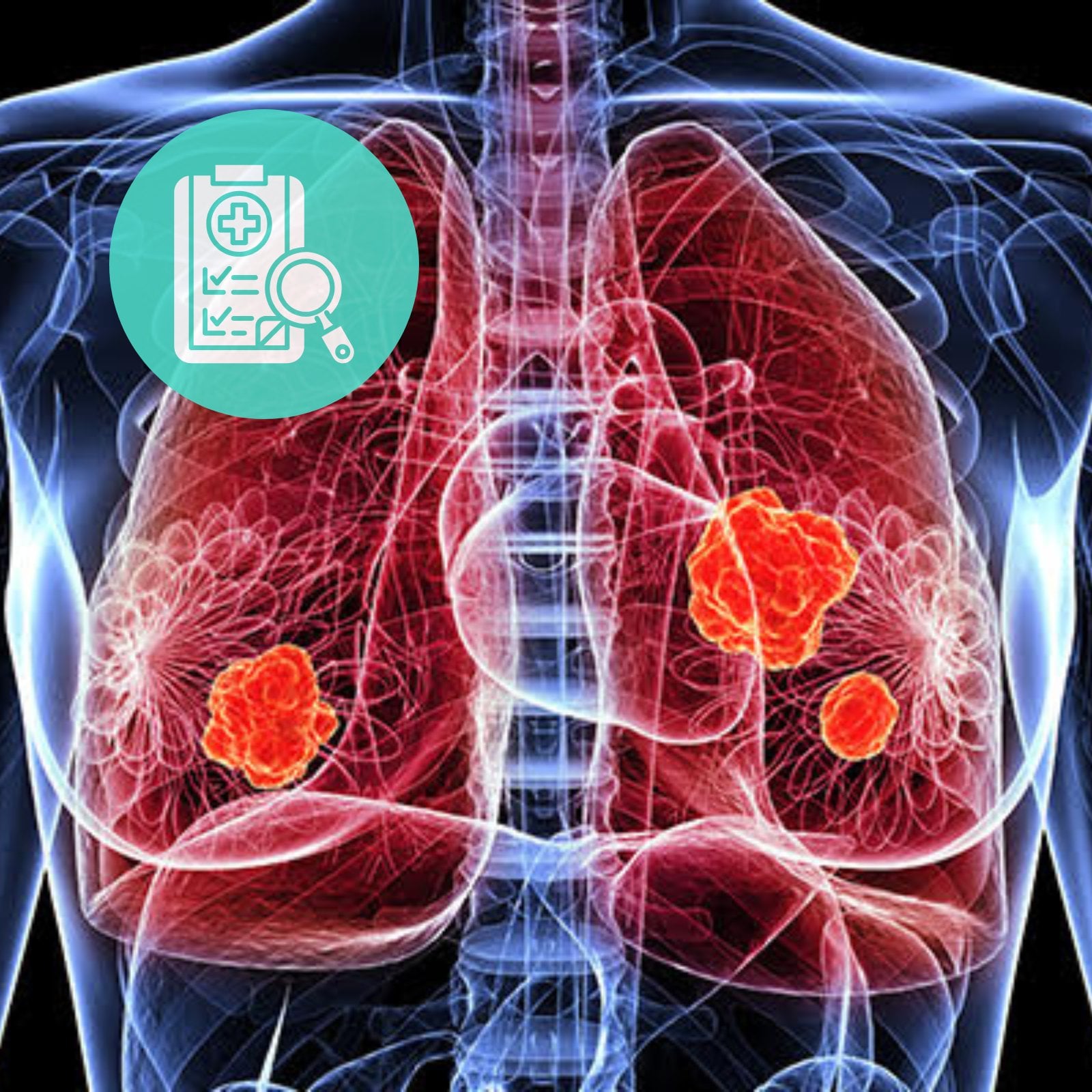 Encouraging news in small-cell lung cancer.
Durvalumab + tarlatamab has met the overall-su